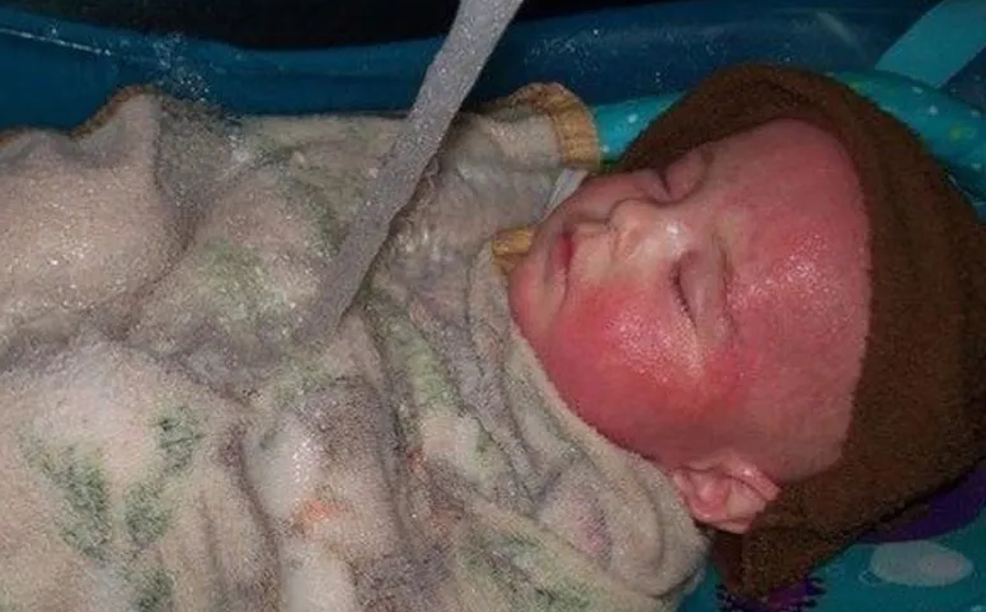 Mom finally discovers what was ‘melting’ her baby’s skin for the first 12 months of his life