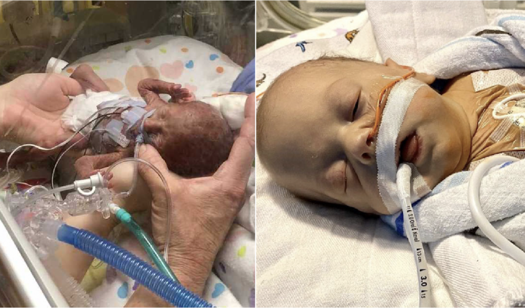 After spending nearly 4 months in the NICU, 1-pound premature baby who