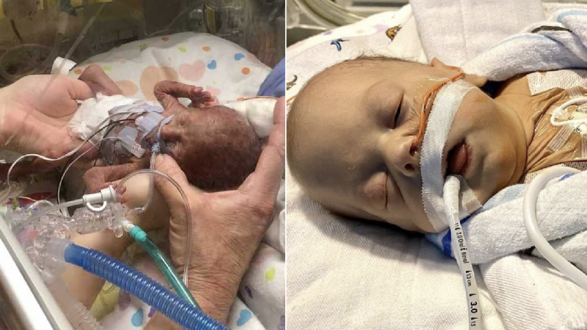 After spending nearly 4 months in the NICU, 1-pound premature baby who suffered from countless health issues due to his early birth defied all odds and is now a thriving toddler