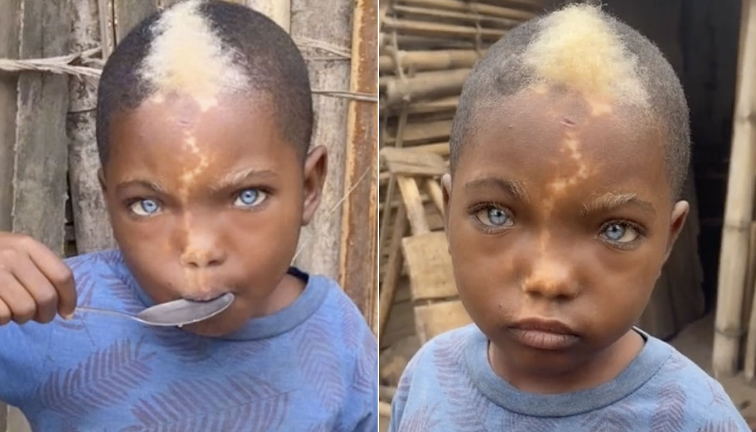 Boy with white hairs, lightning mark down his face and natural blue eyes goes viral because of his distinctive features