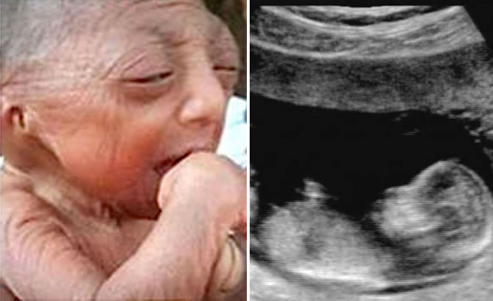 Teenage mom delivered baby with an extremely rare condition, but wait until you see what he looks like today!