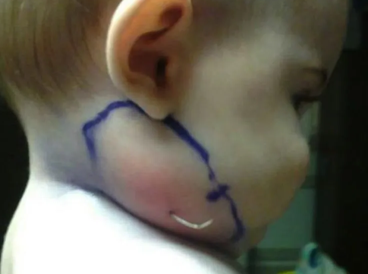 Parents panicked when they saw a lump growing on their baby’s neck, ‘doctors were baffled when they discovered the cause’!