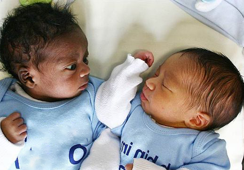 Moments after the birth of these twins, ‘the doctors discovered a one in a million secret’!