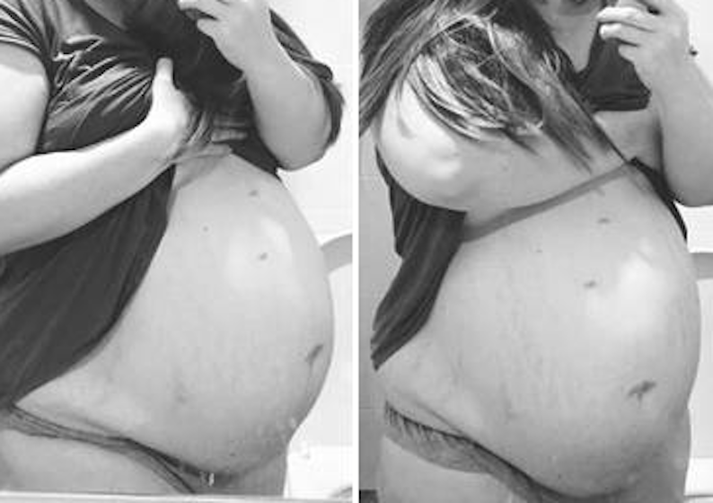 Mother’s belly never stopped growing, ‘then doctors panicked and asked her to sacrifice her baby’!