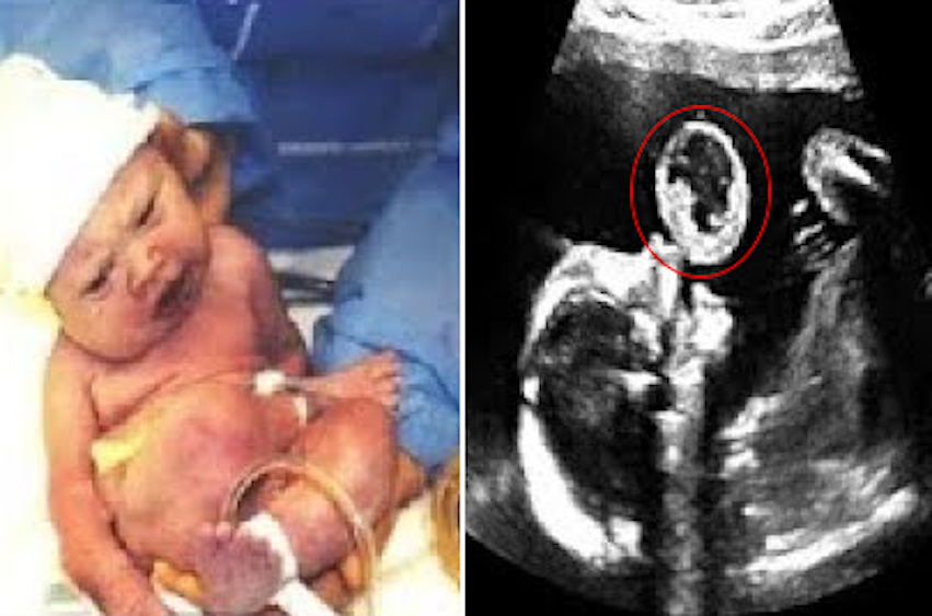 Mother saw baby ‘blowing bubble’ on ultrasound, doctor revealed the truth and told her to abort!